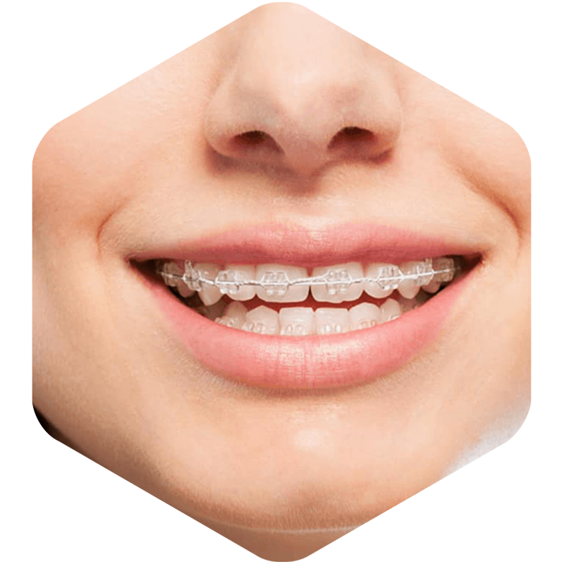Female with ceramic braces